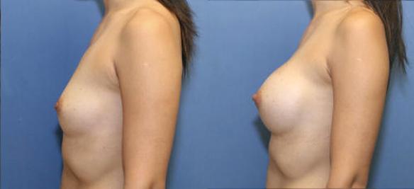 breast enlargement A cup size to a C cup size Asian female